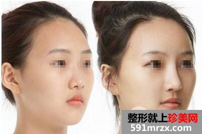 自体耳软骨隆鼻价格 自体软骨隆鼻整形手术效果如何