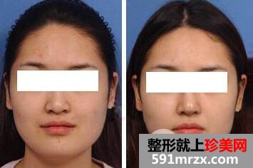 鼻头缩小手术价格 鼻头缩小整形全过程对比图