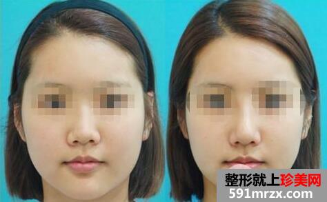 鼻头缩小手术价格 鼻头缩小整形全过程对比图