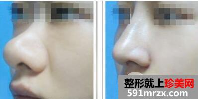 鼻头缩小手术价格 鼻头缩小整形全过程对比图