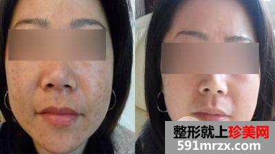 激光全身美白多少钱 激光美白的术后效果怎么样呢