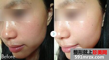 激光全身美白多少钱 激光美白的术后效果怎么样呢