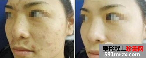 像素激光去痘印多少钱 像素激光整形的效果怎么样