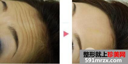 怎样清除抬头纹 去抬头纹最好的方法有哪些