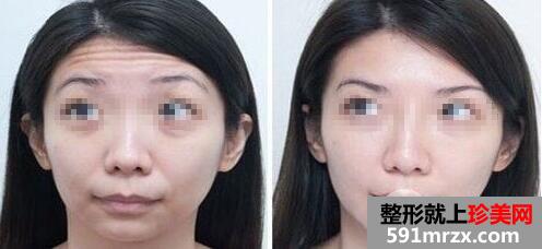 怎样清除抬头纹 去抬头纹最好的方法有哪些