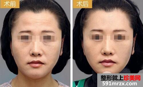 怎样清除抬头纹 去抬头纹最好的方法有哪些