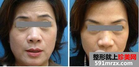 怎样清除抬头纹 去抬头纹最好的方法有哪些