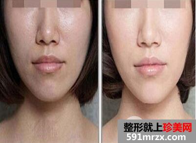 脸部脱毛手术多少钱 永久性脱毛效果对比图