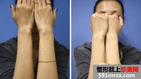 脸部脱毛手术多少钱 永久性脱毛效果对比图