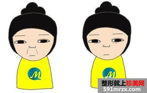注射丰鼻唇沟多少钱 自体脂肪丰鼻唇沟效果怎么样