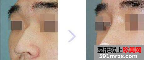 鼻梁矫正手术多少钱 鼻梁骨矫正手术疼吗