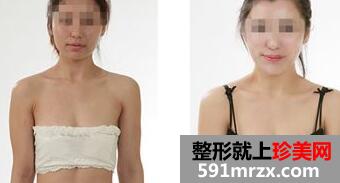 广州自体脂肪隆胸多少钱