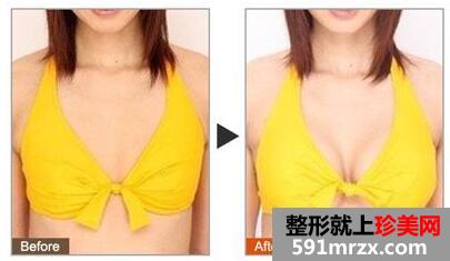 重庆自体脂肪丰胸一般多少钱