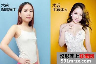 宁波自体脂肪隆胸价格多少钱