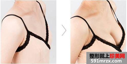 南通自体脂肪隆胸价格多少钱