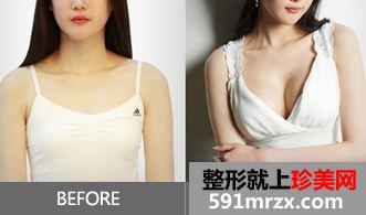 唐山自体脂肪隆胸多少钱