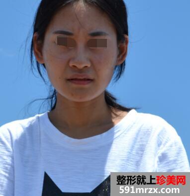 硅胶隆鼻前后对比照 嘚瑟下!