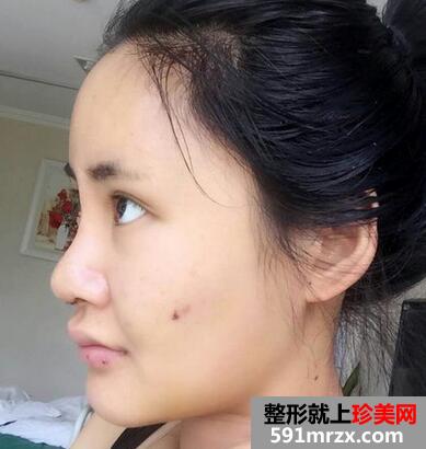 硅胶隆鼻前后对比照 嘚瑟下!