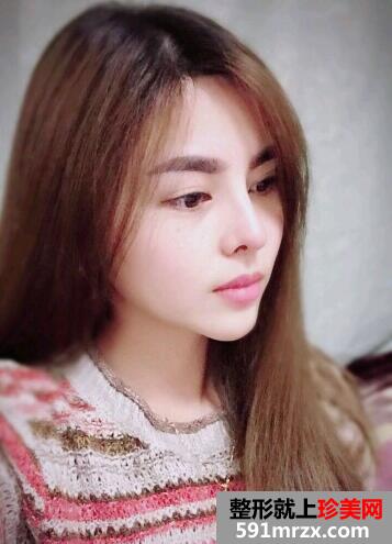 垫鼻头前后效果对比图