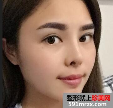 垫鼻头前后效果对比图