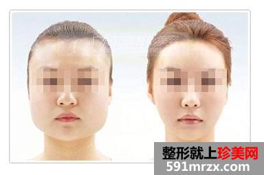 整瓜子脸需要多少钱