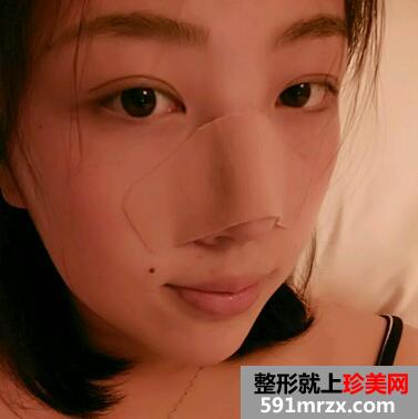 鼻头缩小对比图 鼻头缩小前后对比