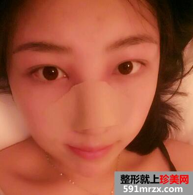 鼻头缩小对比图 鼻头缩小前后对比
