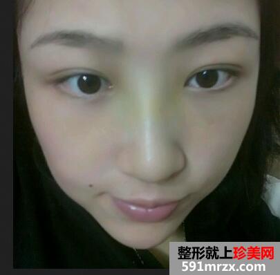 鼻头缩小对比图 鼻头缩小前后对比