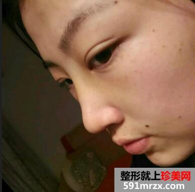 鼻头缩小对比图 鼻头缩小前后对比