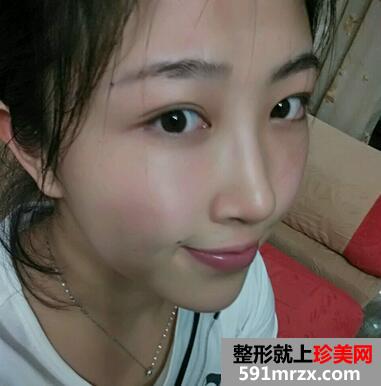 鼻头缩小对比图 鼻头缩小前后对比