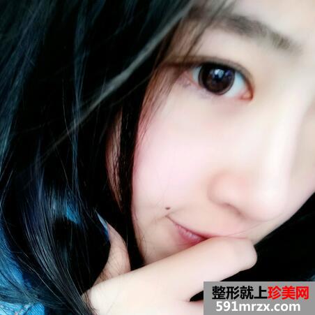 鼻头缩小对比图 鼻头缩小前后对比