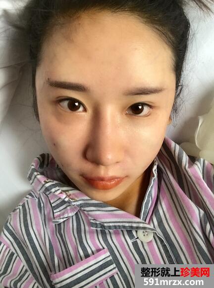 自体脂肪填充颞部 自体脂肪填充后恢复图