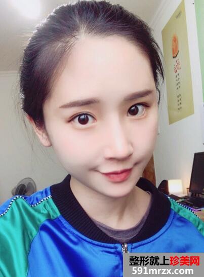 自体脂肪填充颞部 自体脂肪填充后恢复图