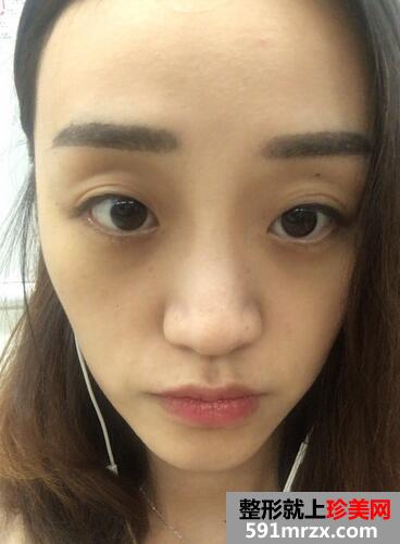 自体脂肪填充苹果机+面颊三个月恢复记录