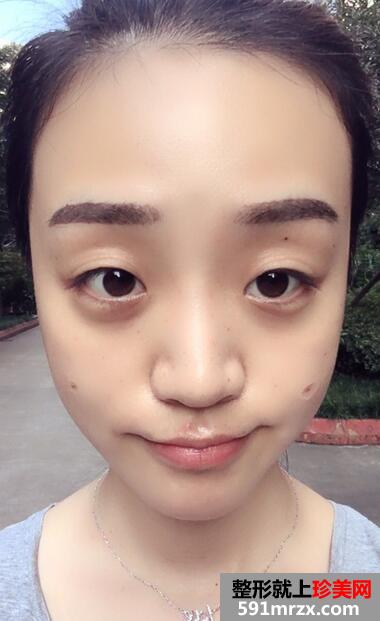 自体脂肪填充苹果机+面颊三个月恢复记录