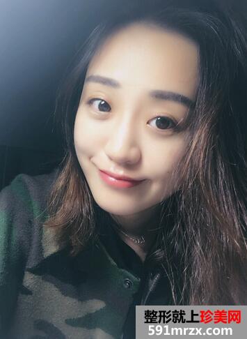 自体脂肪填充苹果机+面颊三个月恢复记录
