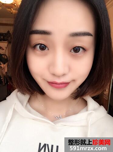 自体脂肪填充苹果机+面颊三个月恢复记录