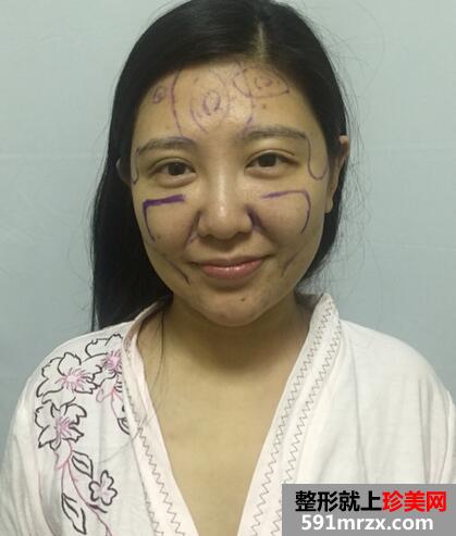 面部吸脂后4个月效果图 面部吸脂亲身经历