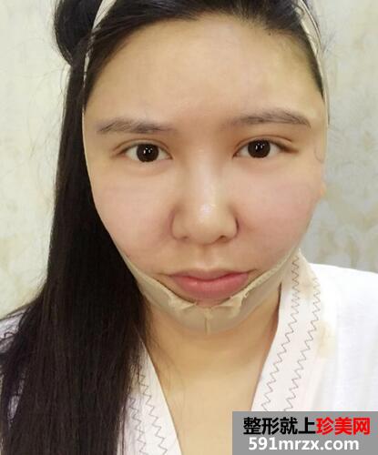 面部吸脂后4个月效果图 面部吸脂亲身经历