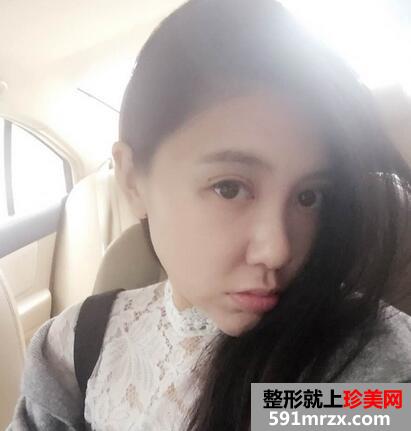 面部吸脂后4个月效果图 面部吸脂亲身经历