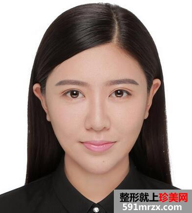 面部吸脂后4个月效果图 面部吸脂亲身经历