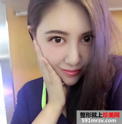 面部吸脂后4个月效果图 面部吸脂亲身经历