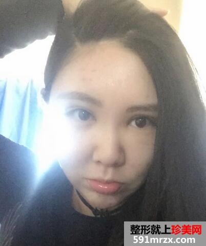 面部吸脂后4个月效果图 面部吸脂亲身经历
