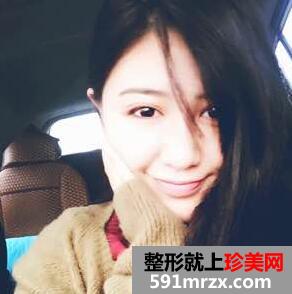 面部吸脂后4个月效果图 面部吸脂亲身经历