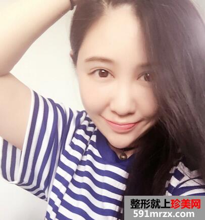 面部吸脂后4个月效果图 面部吸脂亲身经历