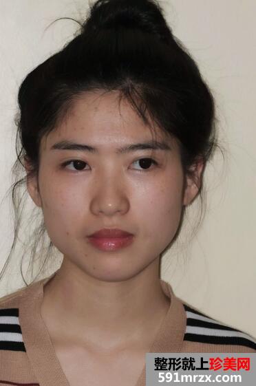 下颌角整形案例 下颌角磨骨整形恢复记录