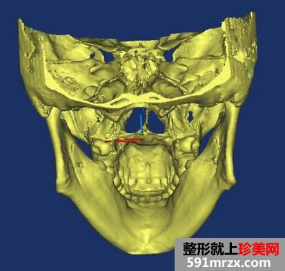 下颌角整形案例 下颌角磨骨整形恢复记录