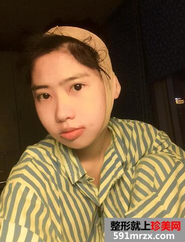 下颌角整形案例 下颌角磨骨整形恢复记录