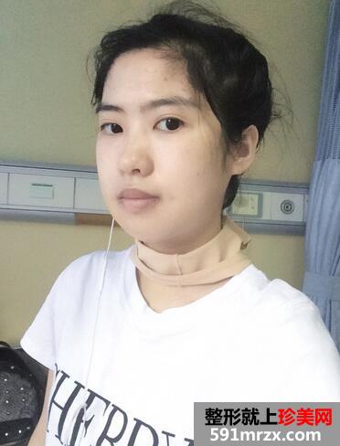 下颌角整形案例 下颌角磨骨整形恢复记录