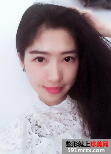 下颌角整形案例 下颌角磨骨整形恢复记录